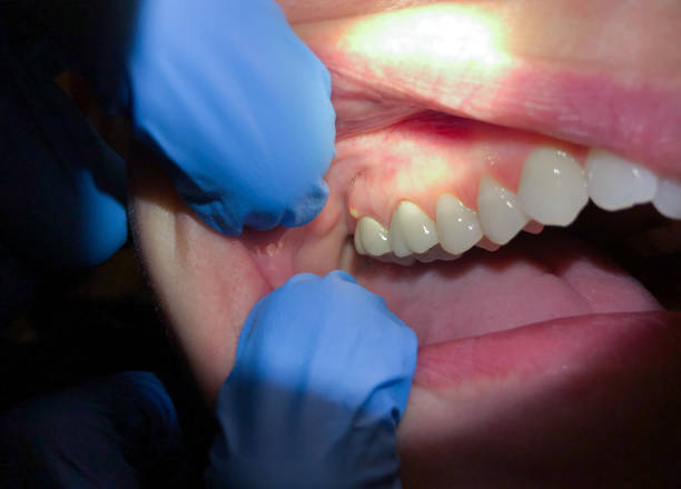 Best Emergency Dental Care for Abscessed Tooth in Edgewood, IN